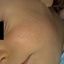42. Фолликулярный кератоз у ребенка фото