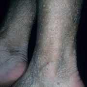 Кератоз на ногах