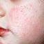 2. Кератоз кожи лица фото
