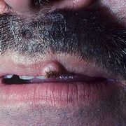 Кератоакантома губы