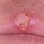 2. Кератоакантома губы фото