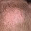 3. Экзема волосистой части головы фото