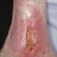 12. Контактный дерматит на ногах фото
