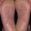 14. Контактный дерматит на ногах фото
