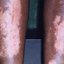 16. Контактный дерматит на ногах фото
