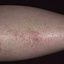 17. Контактный дерматит на ногах фото