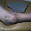 2. Контактный дерматит на ногах фото