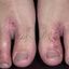 25. Контактный дерматит на ногах фото