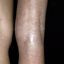5. Контактный дерматит на ногах фото