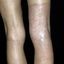 7. Контактный дерматит на ногах фото