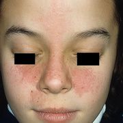 Аллергический контактный дерматит у детей