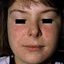 3. Аллергический контактный дерматит у детей фото