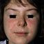 4. Аллергический контактный дерматит у детей фото