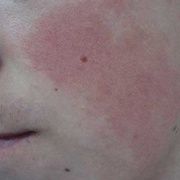Гиперкератоз кожи лица