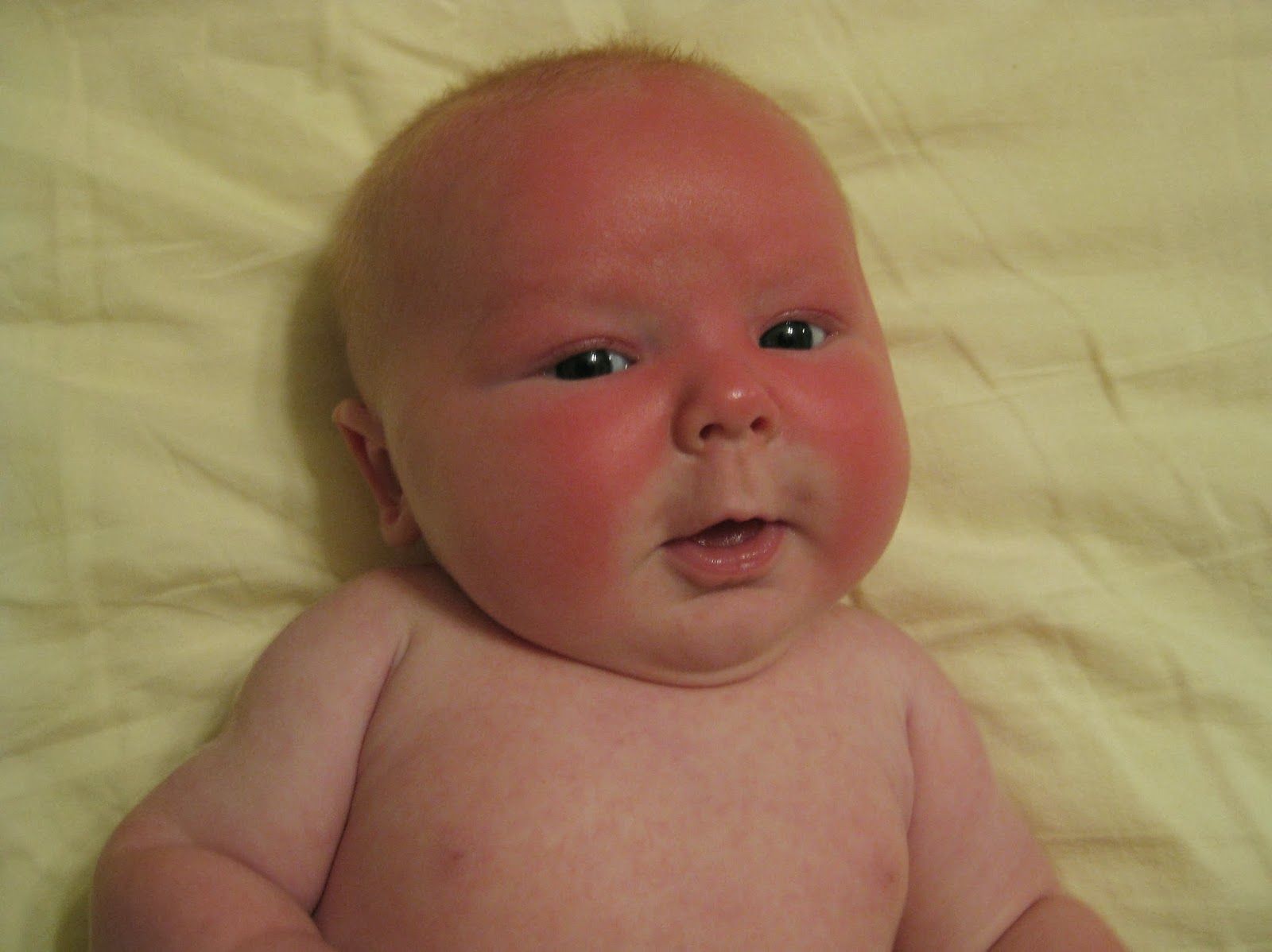 У ребенка горят щеки. Солнечный ожог на лице у ребенка. Солнечный ожог у новорожденного.