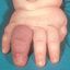 2. Гемангиома на пальце руки фото