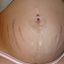 6. Растяжки при беременности фото