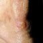 11. Рак кожи на носу фото