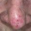 2. Рак кожи на носу фото