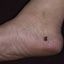 11. Рак кожи на ноге фото