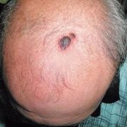 Рак кожи головы